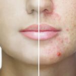 acne cleyo skin experts