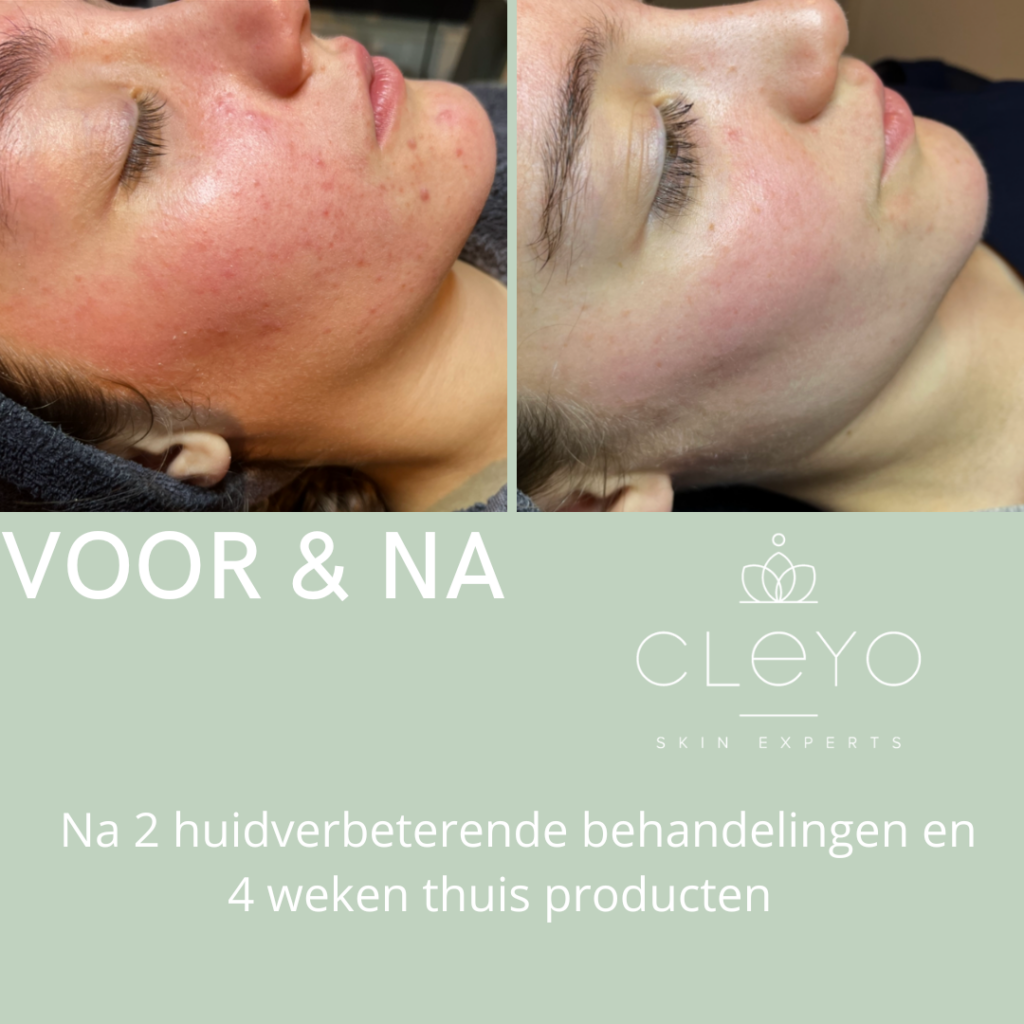 Voor & na zara cleyo resultaat huidverbeterende producte cleyo beauty products